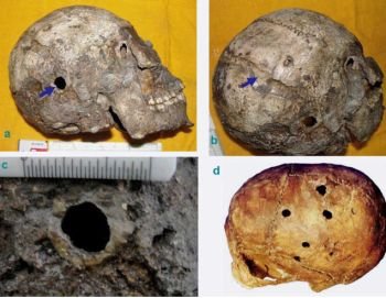 Human Skull with World’s Oldest Successful Brain Surgery discovered in India